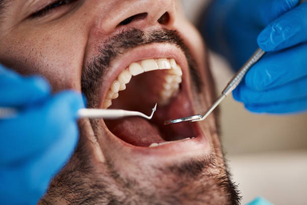 Best Emergency Tooth Extraction in Essexville, MI